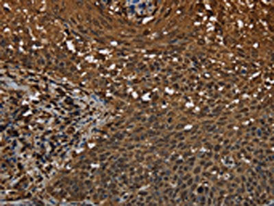 The image on the left is immunohistochemistry of paraffin-embedded Human cervical cancer tissue using CSB-PA014278(MYBBP1A Antibody) at dilution 1/40, on the right is treated with synthetic peptide. (Original magnification: ×200)
