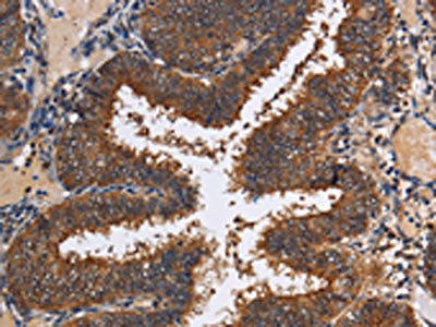 The image on the left is immunohistochemistry of paraffin-embedded Human colon cancer tissue using CSB-PA014309(LRRC57 Antibody) at dilution 1/40, on the right is treated with fusion protein. (Original magnification: ×200)