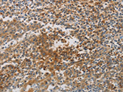 The image on the left is immunohistochemistry of paraffin-embedded Human tonsil tissue using CSB-PA014412(CKMT1A/CKMT1B Antibody) at dilution 1/80, on the right is treated with synthetic peptide. (Original magnification: ×200)