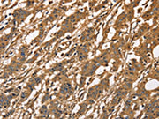 The image on the left is immunohistochemistry of paraffin-embedded Human gastic cancer tissue using CSB-PA014561(CAPZA3 Antibody) at dilution 1/40, on the right is treated with fusion protein. (Original magnification: ×200)