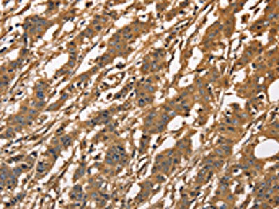 The image on the left is immunohistochemistry of paraffin-embedded Human gastic cancer tissue using CSB-PA014561(CAPZA3 Antibody) at dilution 1/40, on the right is treated with fusion protein. (Original magnification: ×200)