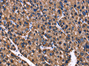The image on the left is immunohistochemistry of paraffin-embedded Human liver cancer tissue using CSB-PA014587(PHB Antibody) at dilution 1/40, on the right is treated with fusion protein. (Original magnification: ×200)