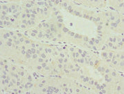 Immunohistochemistry of paraffin-embedded human liver cancer using CSB-PA014635ESR1HU at dilution of 1:100