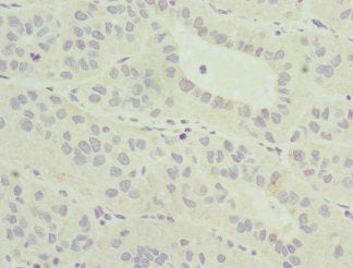 Immunohistochemistry of paraffin-embedded human liver cancer using CSB-PA014635ESR1HU at dilution of 1:100