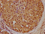 IHC image of CSB-PA014666LA01HU diluted at 1:200 and staining in paraffin-embedded human breast cancer performed on a Leica BondTM system. After dewaxing and hydration, antigen retrieval was mediated by high pressure in a citrate buffer (pH 6.0)....