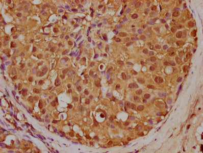 IHC image of CSB-PA014666LA01HU diluted at 1:200 and staining in paraffin-embedded human breast cancer performed on a Leica BondTM system. After dewaxing and hydration, antigen retrieval was mediated by high pressure in a citrate buffer (pH 6.0)....