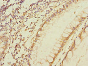 Immunohistochemistry of paraffin-embedded human colon cancer using CSB-PA014776LA01HU at dilution of 1:100