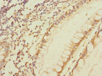 Immunohistochemistry of paraffin-embedded human colon cancer using CSB-PA014776LA01HU at dilution of 1:100