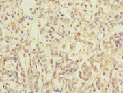 Immunohistochemistry of paraffin-embedded human gastric cancer using CSB-PA014817ESR1HU at dilution of 1:100