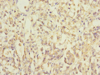 Immunohistochemistry of paraffin-embedded human gastric cancer using CSB-PA014817ESR1HU at dilution of 1:100