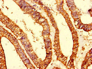 Immunohistochemistry of paraffin-embedded human endometrial cancer using CSB-PA014875LA01HU at dilution of 1:100