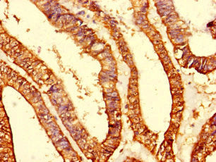 Immunohistochemistry of paraffin-embedded human endometrial cancer using CSB-PA014875LA01HU at dilution of 1:100