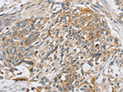 The image on the left is immunohistochemistry of paraffin-embedded Human esophagus cancer tissue using CSB-PA014906(SLC5A6 Antibody) at dilution 1/20, on the right is treated with synthetic peptide. (Original magnification: ×200)