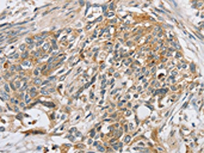 The image on the left is immunohistochemistry of paraffin-embedded Human esophagus cancer tissue using CSB-PA014906(SLC5A6 Antibody) at dilution 1/20, on the right is treated with synthetic peptide. (Original magnification: ×200)
