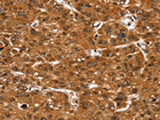 The image on the left is immunohistochemistry of paraffin-embedded Human liver cancer tissue using CSB-PA014989(SMARCB1 Antibody) at dilution 1/35, on the right is treated with fusion protein. (Original magnification: ×200)