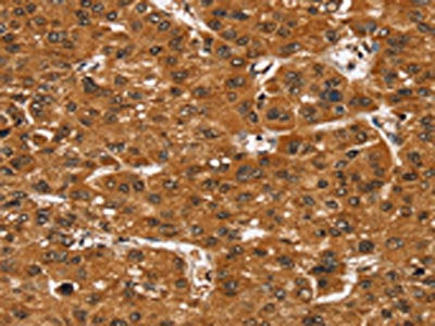 The image on the left is immunohistochemistry of paraffin-embedded Human liver cancer tissue using CSB-PA014989(SMARCB1 Antibody) at dilution 1/35, on the right is treated with fusion protein. (Original magnification: ×200)