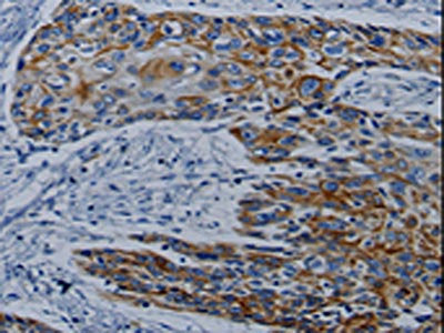 The image on the left is immunohistochemistry of paraffin-embedded Human esophagus cancer tissue using CSB-PA015008(CPT2 Antibody) at dilution 1/10, on the right is treated with synthetic peptide. (Original magnification: ×200)