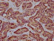 IHC image of CSB-PA015013LA01HU diluted at 1:400 and staining in paraffin-embedded human liver cancer performed on a Leica BondTM system. After dewaxing and hydration, antigen retrieval was mediated by high pressure in a citrate buffer (pH 6.0). S...