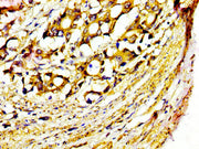 IHC image of CSB-PA015055LA01HU diluted at 1:400 and staining in paraffin-embedded human gastric cancer performed on a Leica BondTM system. After dewaxing and hydration, antigen retrieval was mediated by high pressure in a citrate buffer (pH 6.0)....