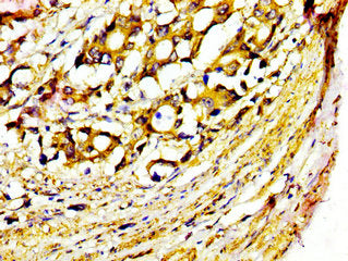 IHC image of CSB-PA015055LA01HU diluted at 1:400 and staining in paraffin-embedded human gastric cancer performed on a Leica BondTM system. After dewaxing and hydration, antigen retrieval was mediated by high pressure in a citrate buffer (pH 6.0)....
