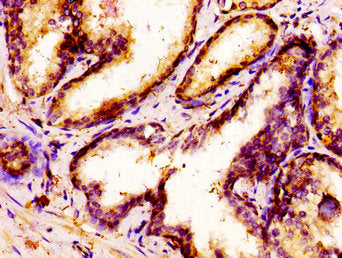 IHC image of CSB-PA015068LA01HU diluted at 1:300 and staining in paraffin-embedded human prostate cancer performed on a Leica BondTM system. After dewaxing and hydration, antigen retrieval was mediated by high pressure in a citrate buffer (pH 6.0)...