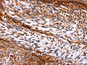 The image on the left is immunohistochemistry of paraffin-embedded Human cervical cancer tissue using CSB-PA015132(PTPN13 Antibody) at dilution 1/20, on the right is treated with synthetic peptide. (Original magnification: ×200)