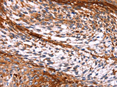 The image on the left is immunohistochemistry of paraffin-embedded Human cervical cancer tissue using CSB-PA015132(PTPN13 Antibody) at dilution 1/20, on the right is treated with synthetic peptide. (Original magnification: ×200)