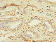Immunohistochemistry of paraffin-embedded human breast cancer using CSB-PA015252LA01HU at dilution of 1:100