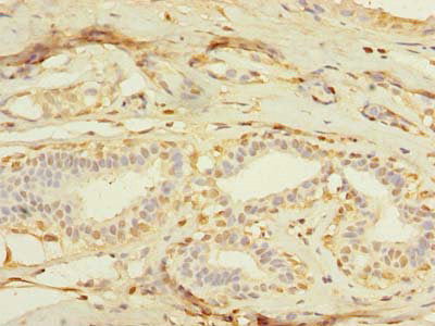 Immunohistochemistry of paraffin-embedded human breast cancer using CSB-PA015252LA01HU at dilution of 1:100