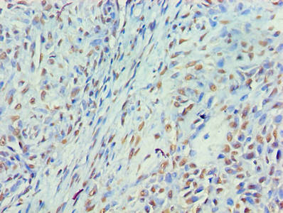 Immunohistochemistry of paraffin-embedded human breast cancer using CSB-PA015283LA01HU at dilution of 1:100