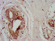 IHC image of CSB-PA015291LA01HU diluted at 1:400 and staining in paraffin-embedded human breast cancer performed on a Leica BondTM system. After dewaxing and hydration, antigen retrieval was mediated by high pressure in a citrate buffer (pH 6.0)....