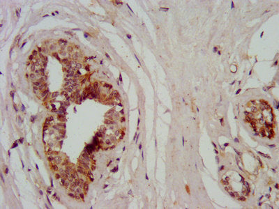 IHC image of CSB-PA015291LA01HU diluted at 1:400 and staining in paraffin-embedded human breast cancer performed on a Leica BondTM system. After dewaxing and hydration, antigen retrieval was mediated by high pressure in a citrate buffer (pH 6.0)....
