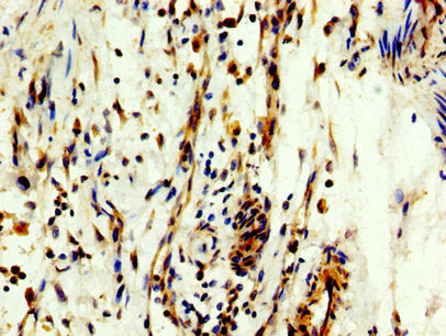 IHC image of CSB-PA015387LA01HU diluted at 1:300 and staining in paraffin-embedded human bladder cancer performed on a Leica BondTM system. After dewaxing and hydration, antigen retrieval was mediated by high pressure in a citrate buffer (pH 6.0)....