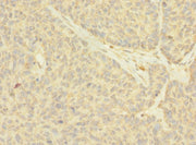 Immunohistochemistry of paraffin-embedded human ovarian cancer using CSB-PA015437LA01HU at dilution of 1:100