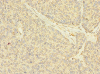 Immunohistochemistry of paraffin-embedded human ovarian cancer using CSB-PA015437LA01HU at dilution of 1:100