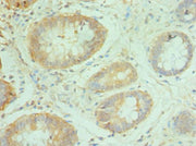 Immunohistochemistry of paraffin-embedded human colon cancer using CSB-PA015521ESR2HU at dilution of 1:100