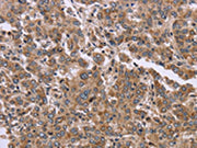 The image on the left is immunohistochemistry of paraffin-embedded Human liver cancer tissue using CSB-PA015538(FAM3B Antibody) at dilution 1/30, on the right is treated with fusion protein. (Original magnification: ×200)