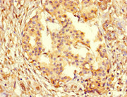 Immunohistochemistry of paraffin-embedded human pancreatic cancer using CSB-PA01567A0Rb at dilution of 1:100