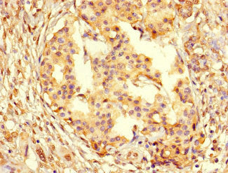Immunohistochemistry of paraffin-embedded human pancreatic cancer using CSB-PA01567A0Rb at dilution of 1:100