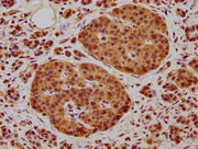 IHC image of CSB-PA015722LA01HU diluted at 1:400 and staining in paraffin-embedded human pancreatic cancer performed on a Leica BondTM system. After dewaxing and hydration, antigen retrieval was mediated by high pressure in a citrate buffer (pH 6....