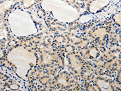 The image on the left is immunohistochemistry of paraffin-embedded Human thyroid cancer tissue using CSB-PA015833(ADAMTS6 Antibody) at dilution 1/20, on the right is treated with synthetic peptide. (Original magnification: ×200)