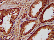 IHC image of CSB-PA015847LA01HU diluted at 1:300 and staining in paraffin-embedded human prostate cancer performed on a Leica BondTM system. After dewaxing and hydration, antigen retrieval was mediated by high pressure in a citrate buffer (pH 6.0)...