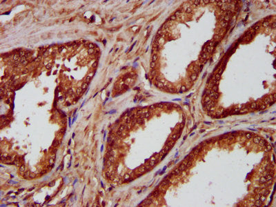 IHC image of CSB-PA015847LA01HU diluted at 1:300 and staining in paraffin-embedded human prostate cancer performed on a Leica BondTM system. After dewaxing and hydration, antigen retrieval was mediated by high pressure in a citrate buffer (pH 6.0)...