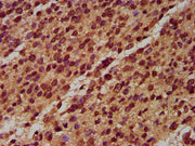 IHC image of CSB-PA015874LA01HU diluted at 1:400 and staining in paraffin-embedded human glioma performed on a Leica BondTM system. After dewaxing and hydration, antigen retrieval was mediated by high pressure in a citrate buffer (pH 6.0). Section...