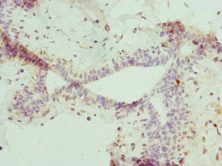 Immunohistochemistry of paraffin-embedded human breast cancer using CSB-PA015889ESR2HU at dilution of 1:100