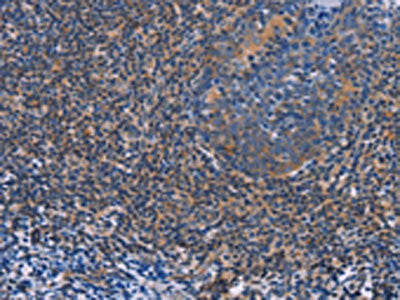 The image on the left is immunohistochemistry of paraffin-embedded Human tonsil tissue using CSB-PA015892(AGFG1 Antibody) at dilution 1/60, on the right is treated with fusion protein. (Original magnification: ×200)