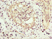 IHC image of CSB-PA015900LA01HU diluted at 1:300 and staining in paraffin-embedded human breast cancer performed on a Leica BondTM system. After dewaxing and hydration, antigen retrieval was mediated by high pressure in a citrate buffer (pH 6.0)....