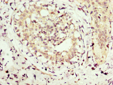 IHC image of CSB-PA015900LA01HU diluted at 1:300 and staining in paraffin-embedded human breast cancer performed on a Leica BondTM system. After dewaxing and hydration, antigen retrieval was mediated by high pressure in a citrate buffer (pH 6.0)....