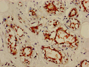 IHC image of CSB-PA015921HA01HU diluted at 1:800 and staining in paraffin-embedded human breast cancer performed on a Leica BondTM system. After dewaxing and hydration, antigen retrieval was mediated by high pressure in a citrate buffer (pH 6.0)....