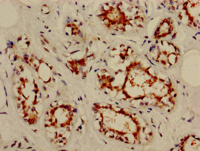 IHC image of CSB-PA015921HA01HU diluted at 1:800 and staining in paraffin-embedded human breast cancer performed on a Leica BondTM system. After dewaxing and hydration, antigen retrieval was mediated by high pressure in a citrate buffer (pH 6.0)....